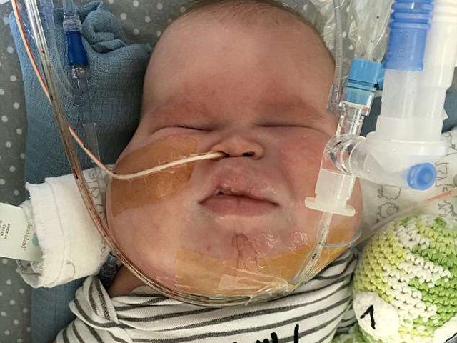 英3个月大男婴囊肿缠面颈哭不出声 妈妈心酸望儿子喊