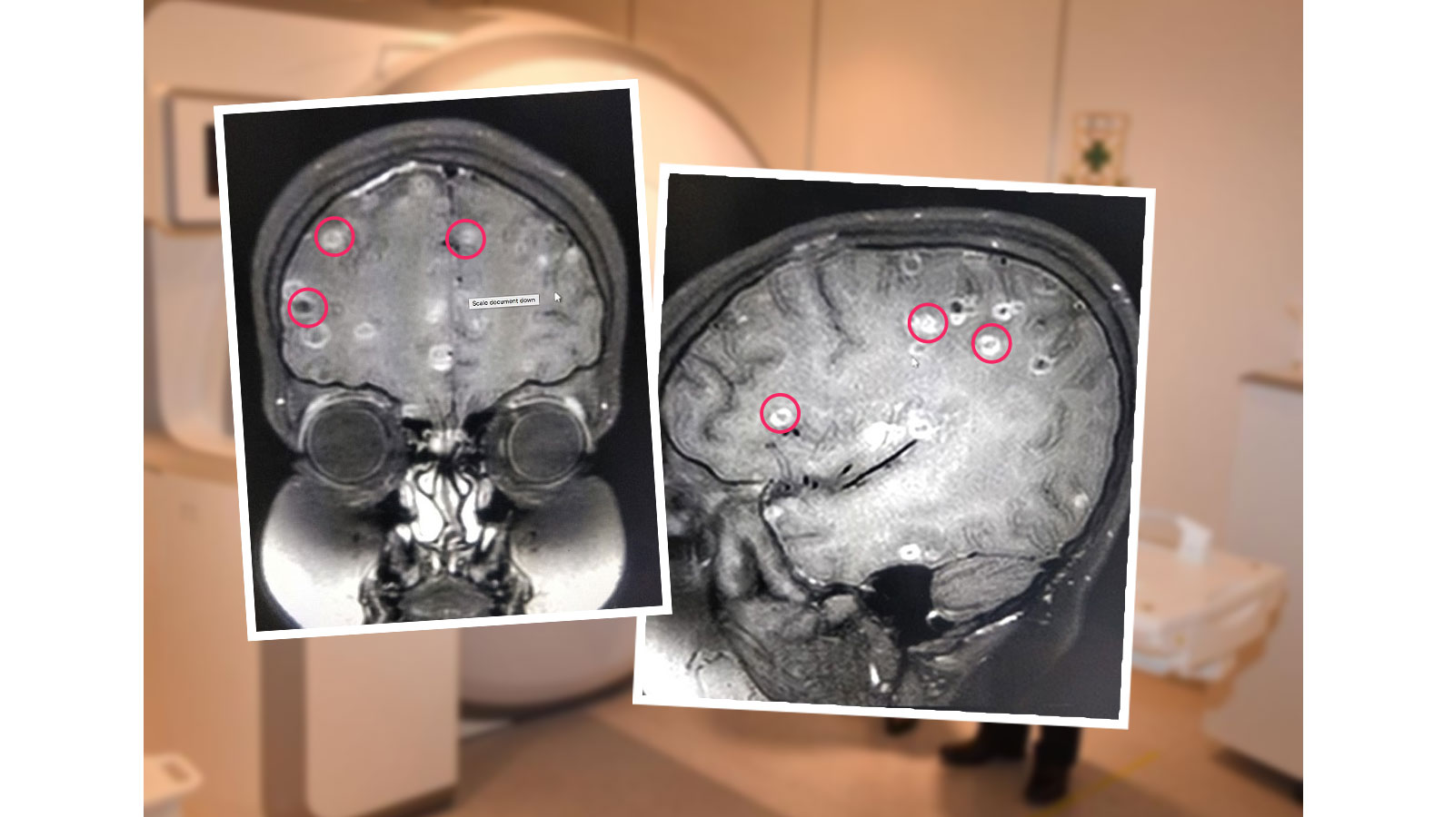 【病从口入】印度8岁女童 脑内惊现过百寄生虫虫卵