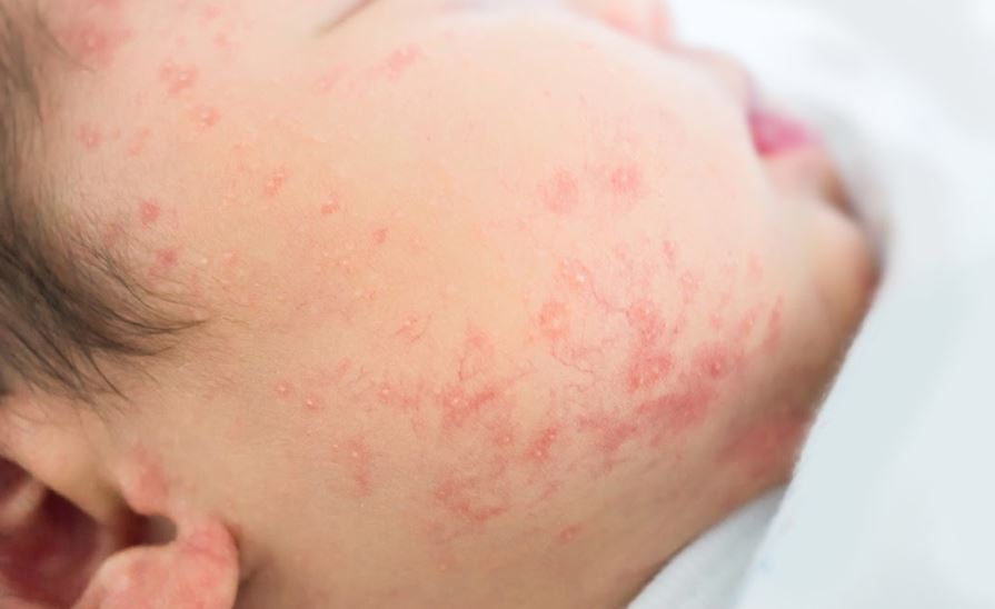 【麻疹vs德国麻疹】助产士教你分清两种疹大不同